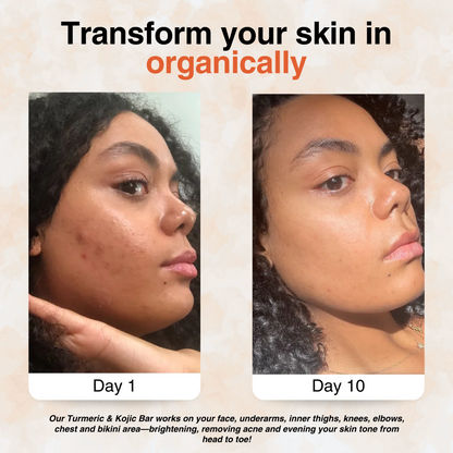 Turmeric & Kojic - Brightening Soap for Clear, Even-Toned Skin